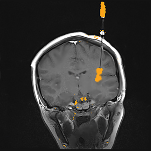 Figure 2 Post Insula Dmap